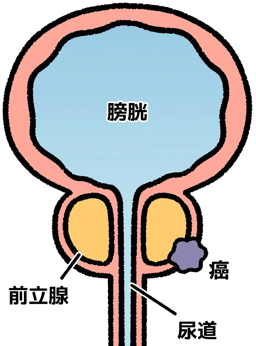 前立腺がんとは