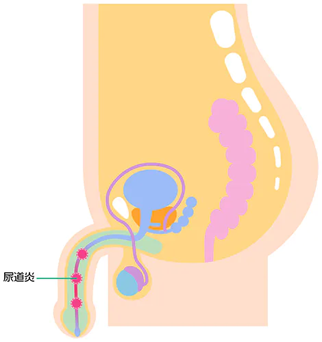 尿道炎とは？どんな症状・原因？