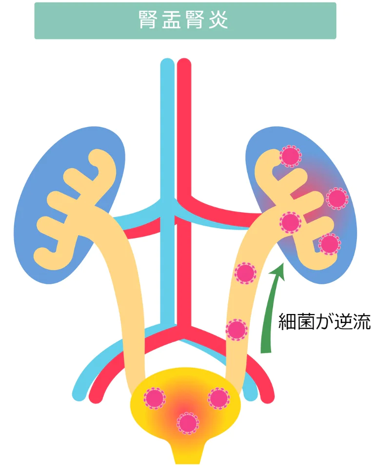 腎盂腎炎とは