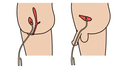 尿道留置カテーテル法