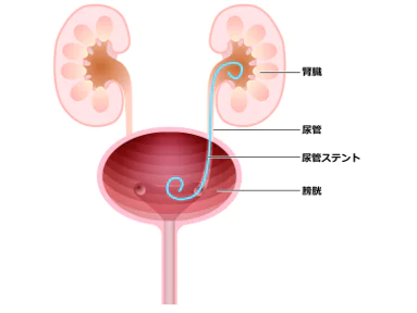 急性腎盂腎炎の治療方法