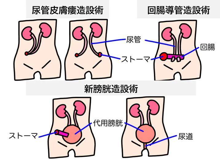 浸潤性膀胱がんの治療方法