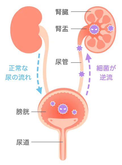 尿路感染症とは？