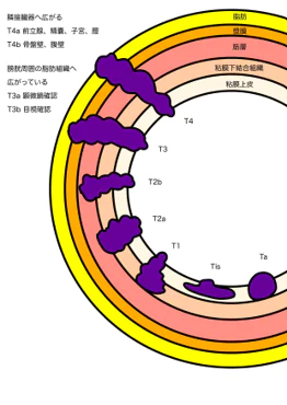 膀胱がんの治療方法