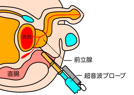 組織検査(前立腺針生検)